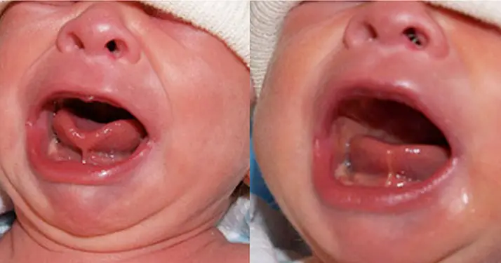 chiropractic wall township nj tongue ties