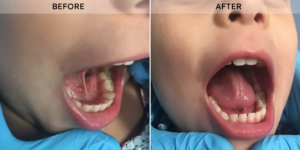 Blog 9 Tongue Tie Release before after