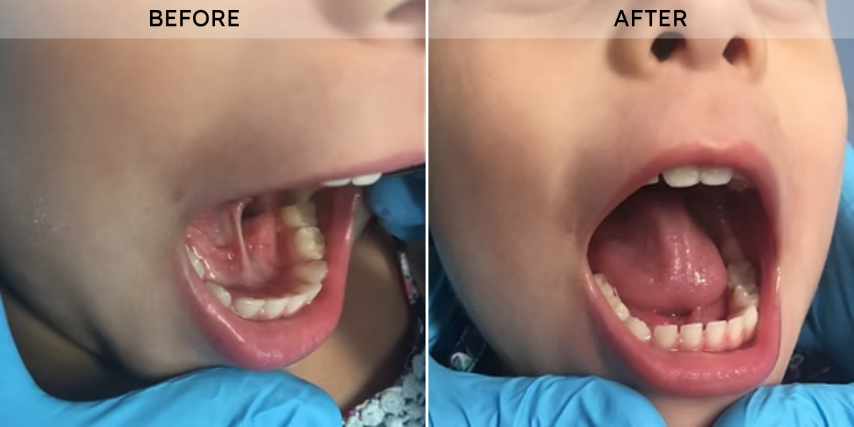 Tongue Tie Release before after