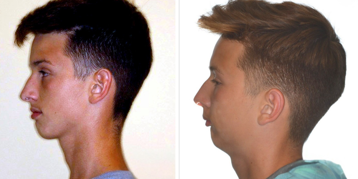 Why Mouth Breathing Affects Facial Development in Children