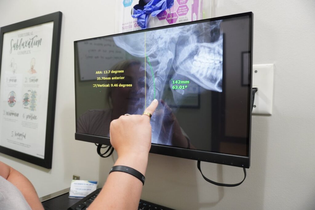 A chiropractor pointing to the upper neck on a lateral x-ray that also shows the jaw and teeth